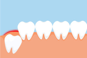 Chirurgiczna ekstracja zęba mądrości (ósemki) jest potrzebna szczególnie w tym przypadku.