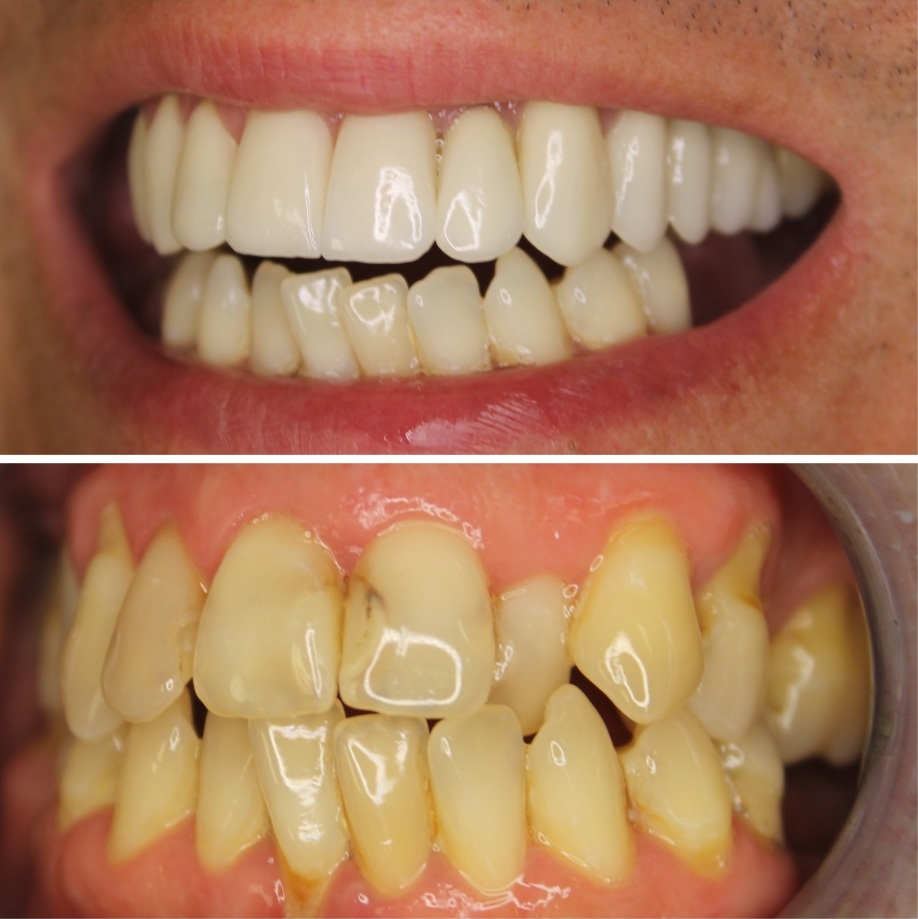 Korony i mosty ceramiczne - zdjęcie przed i po leczeniu