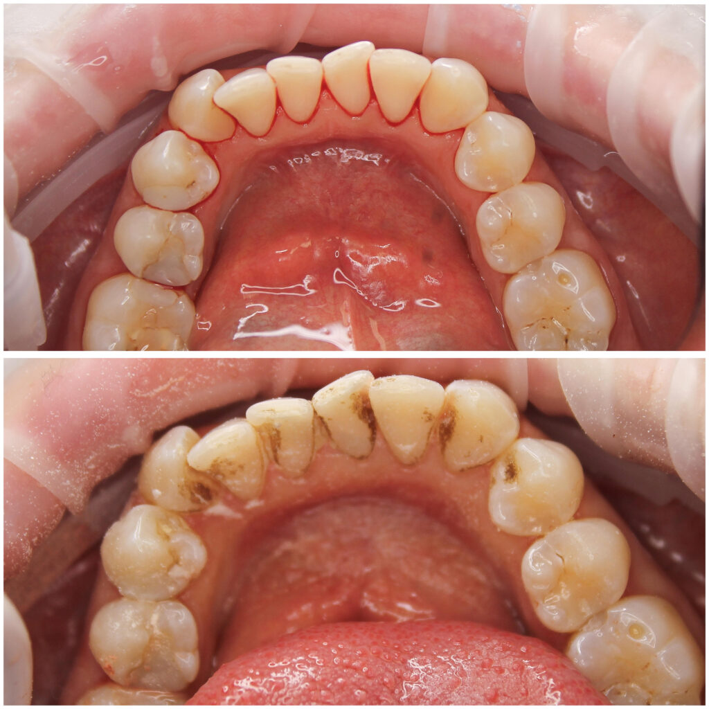 Profilaktyka stomatologiczna - zdjęcia przed i po czyszczeniu zębów w gabinecie stomatologicznym.