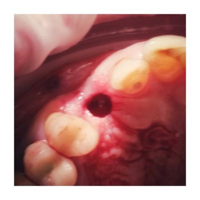 Przygotowane miejsce (łoże) osadzenia implantu.