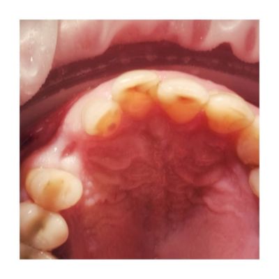 Miejsce wszczepienia implantu