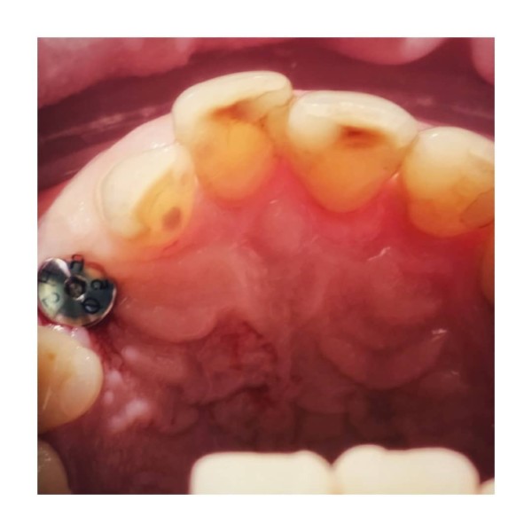 Wszczepiony implant ze śrubą gojącą.