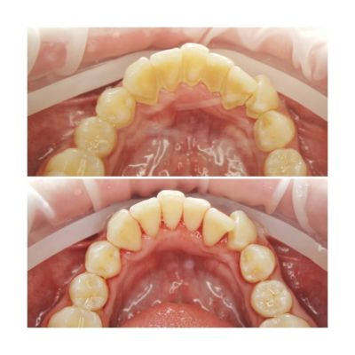 Scaling - zdjęcia przed i po zabiegu