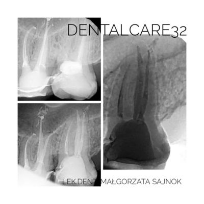 Ząb uszkodzony leczony kanałowo.