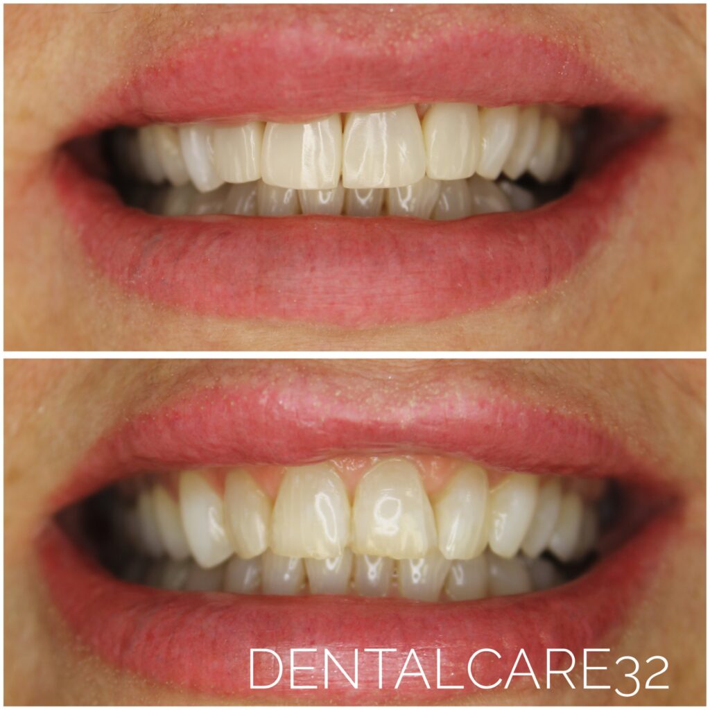 Bonding biomimetyczny - efekty przed i po.