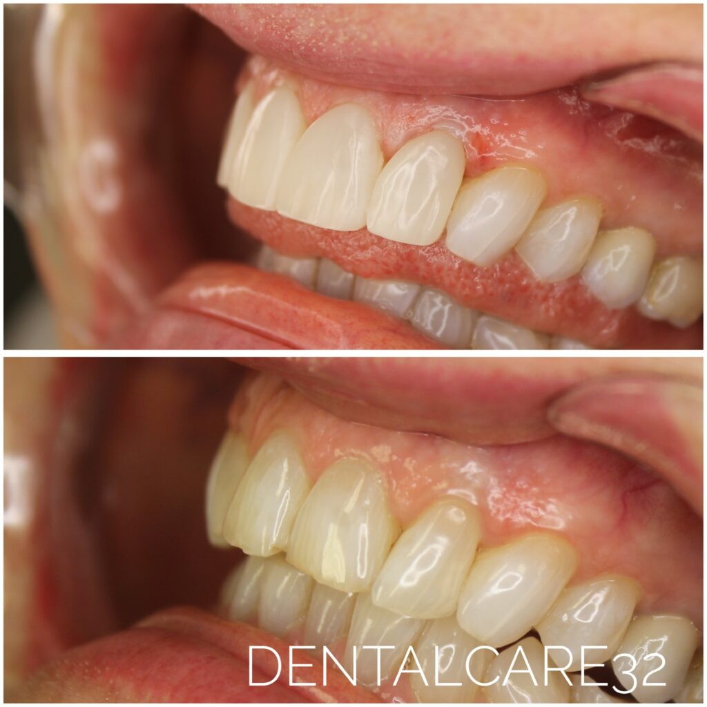 Bonding zebów- efekty przed i po.
