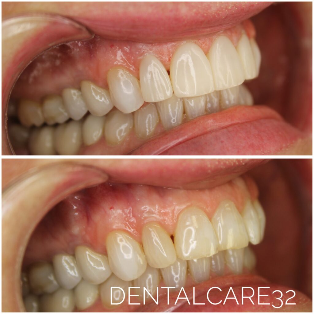 Biomimetyczny bonding zębów - efekty przed i po.