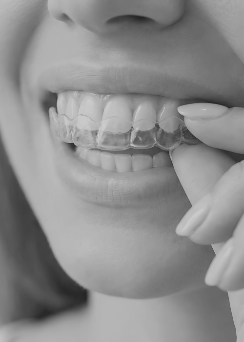 Przezroczysta nakładka Invisalign na zębach pacjentki